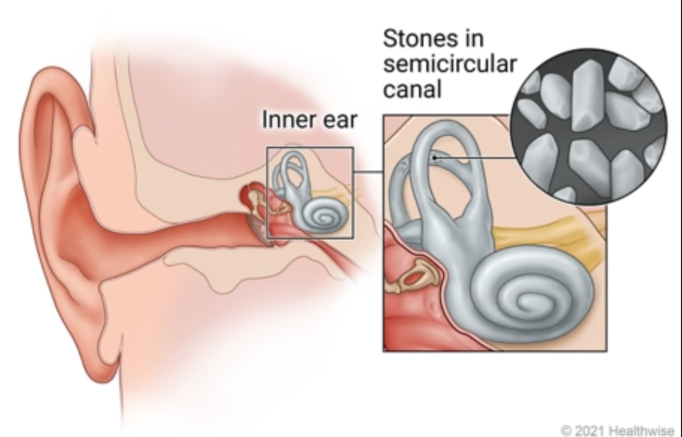 labyrinthitis ear - Inner ear Stones in semicircular canal 2021 Healthwise